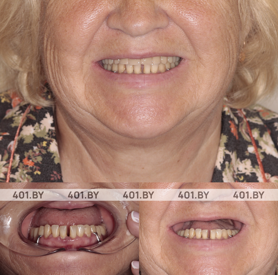 Комплексное восстановление верхней челюсти с костной пластикой. До